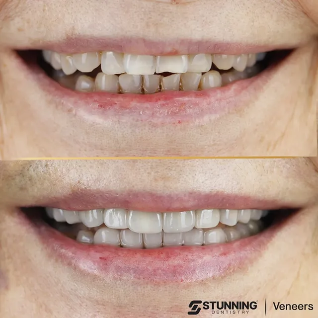 Smile Makeover, USA - photo 4